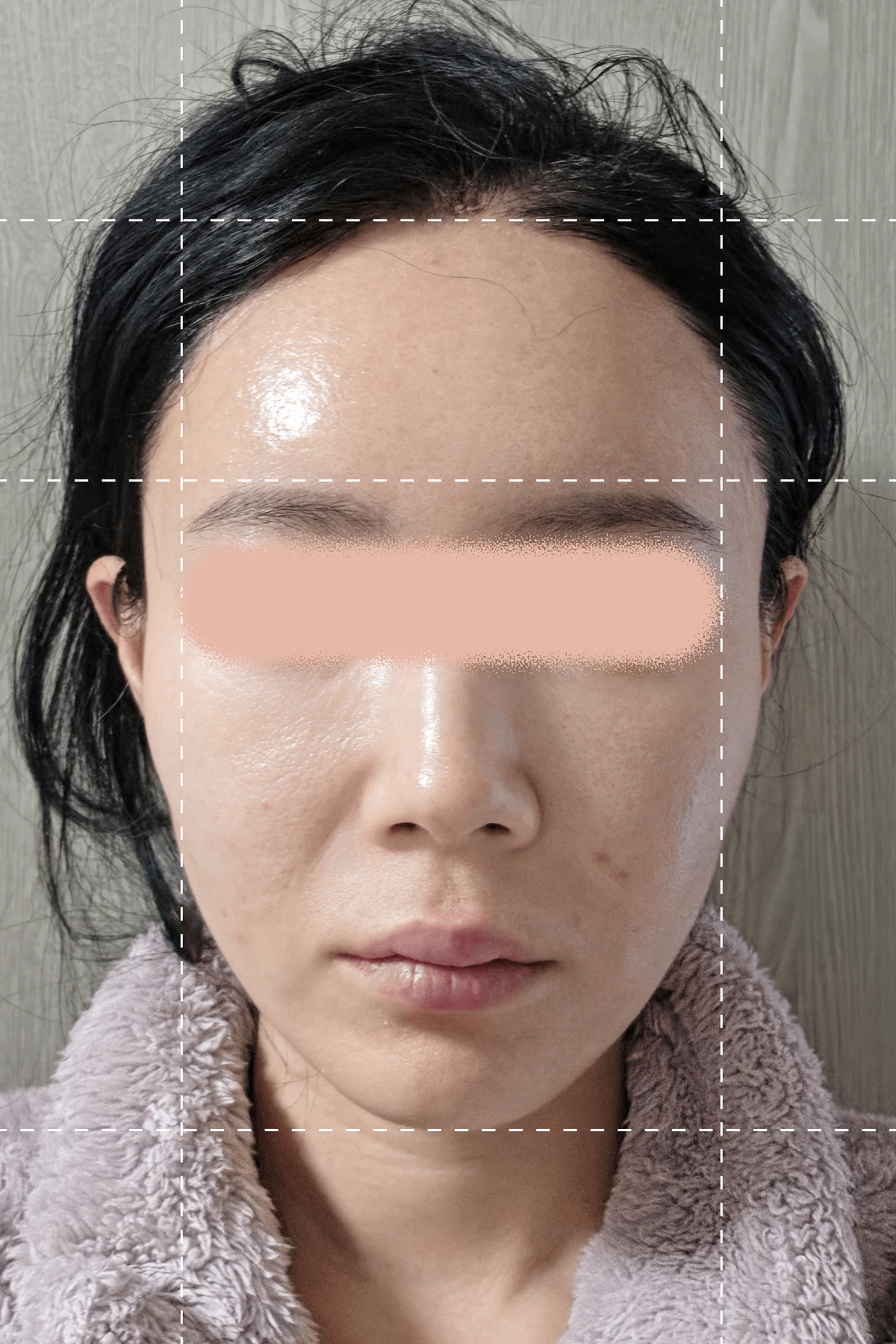 這張照片拍攝於線雕療程之前。