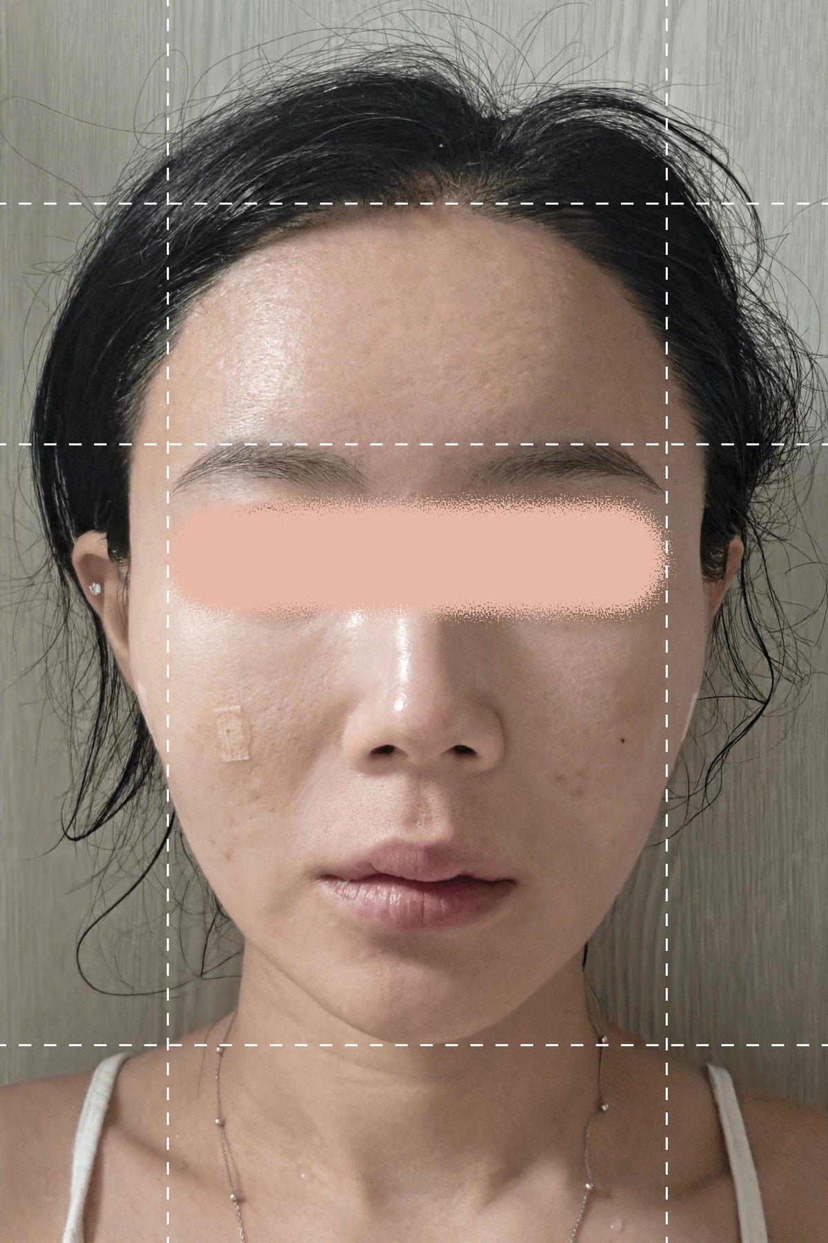 照片拍攝於線雕療程一周