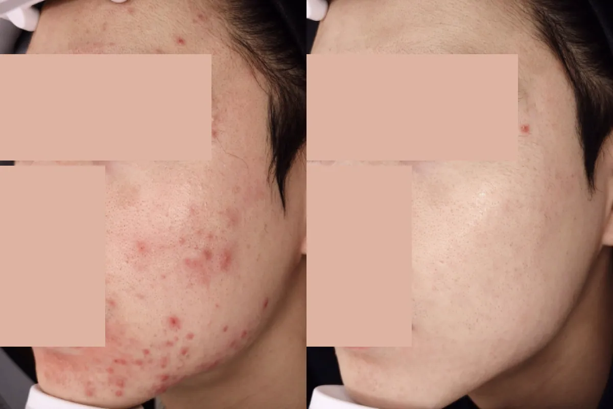 嚴重膿皰性痤瘡治療前後對照照片