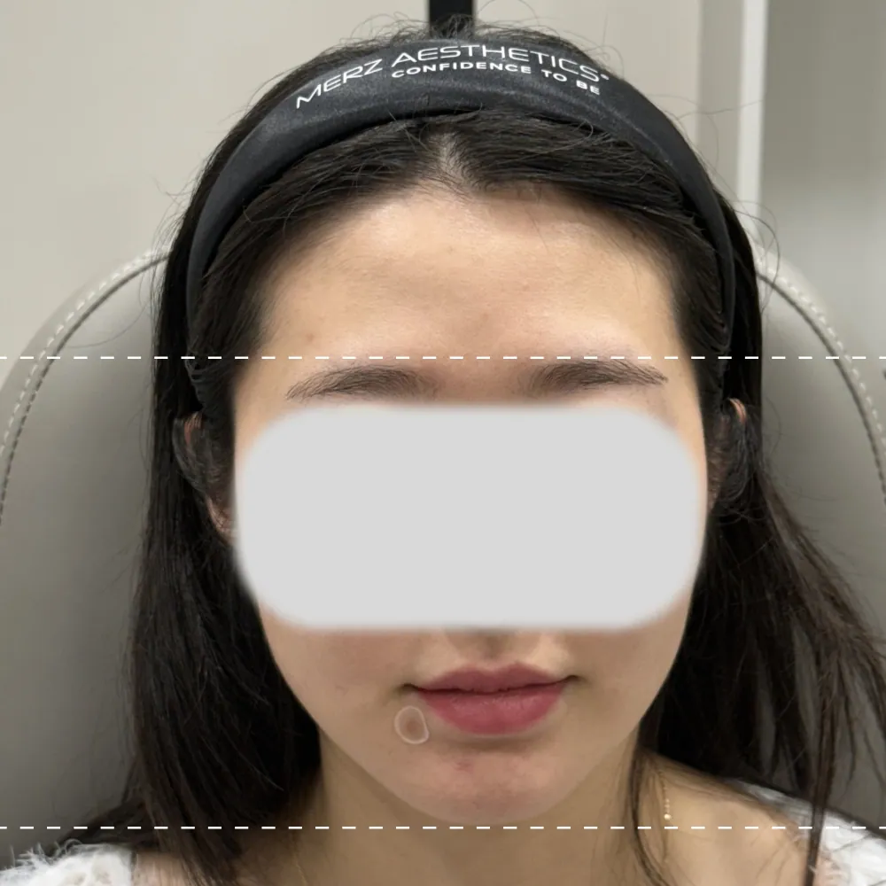 額頭填充療程前