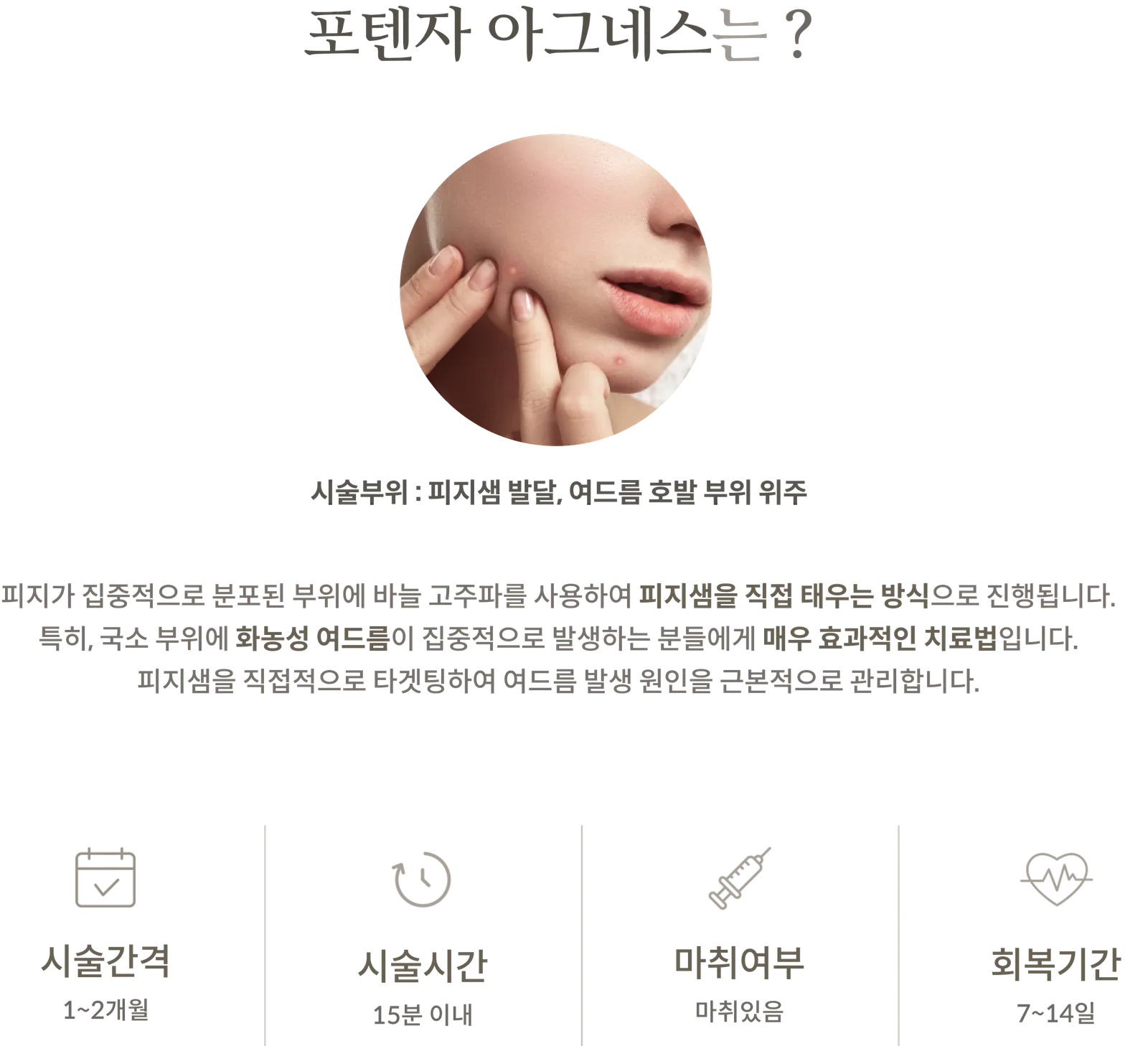 Potenza Agnes療程資訊面板：療程區域主要針對皮脂腺發育和易長痤瘡的區域；解釋使用針式射頻直接燒灼皮脂腺的方法；療程間隔 1-2 個月；療程時間不超過 15 分鐘；採用麻醉；恢復期 7-14 天。