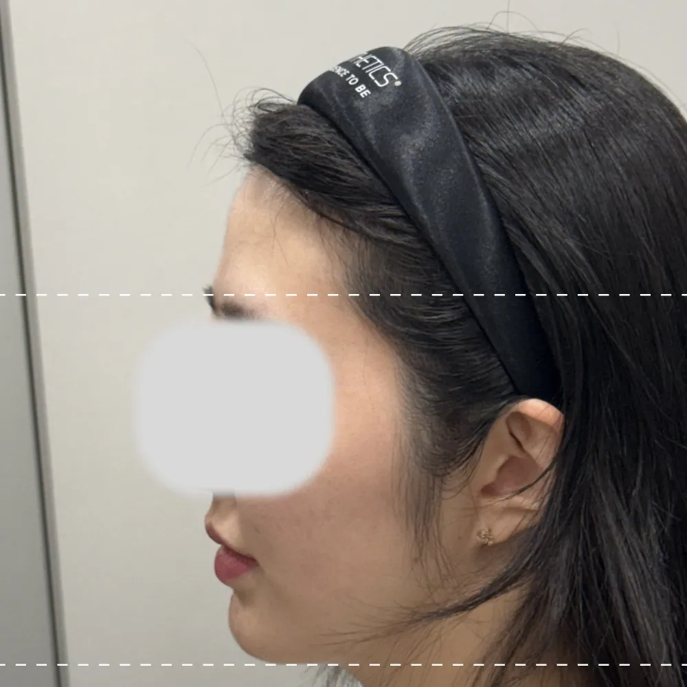 療程前額部填充物呈90度角
