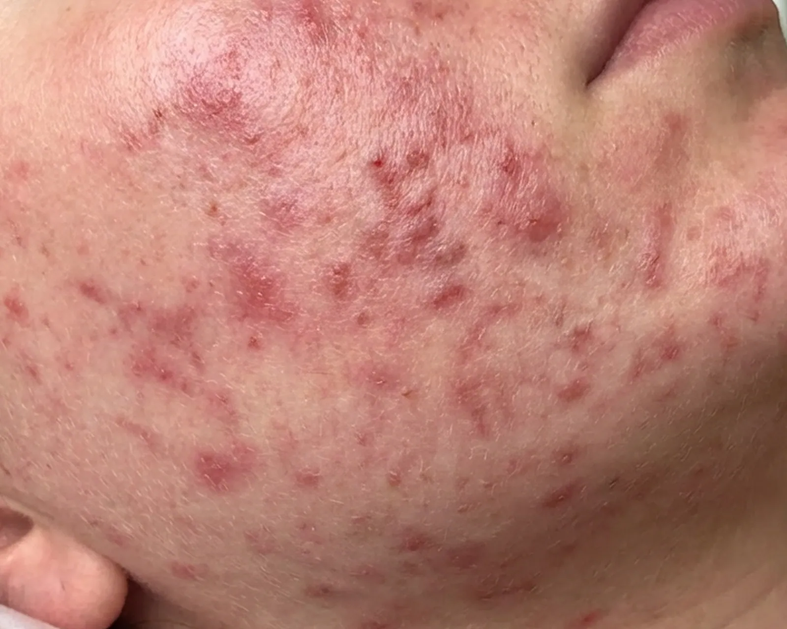 發炎後色素沉著