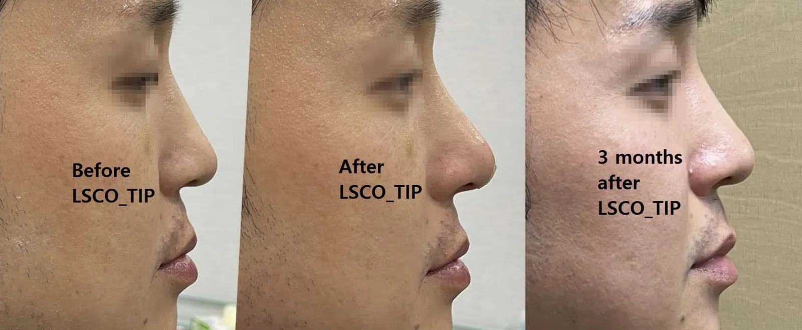 LSCO鼻尖療程前、手術後即刻及術後3個月的側面輪廓比較照片