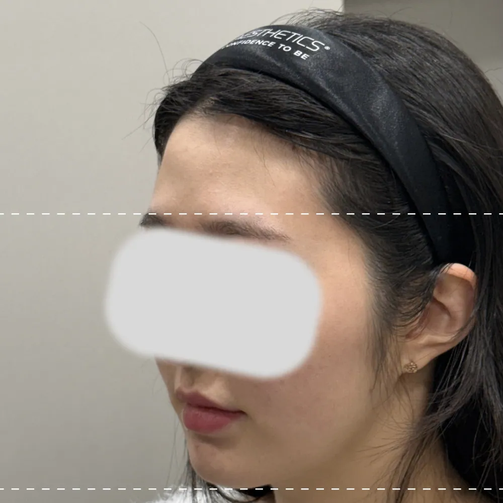 療程前額部填充物呈45度角。
