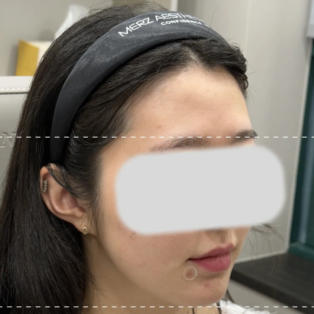 療程前右側額部填充物呈45度角